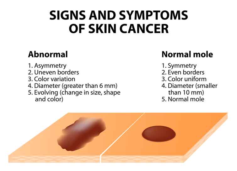 Photos of Skin Cancer Symptoms Are Great Tools